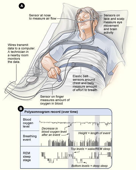 What Does One SOREMP Mean?  Hypersomnia Foundation